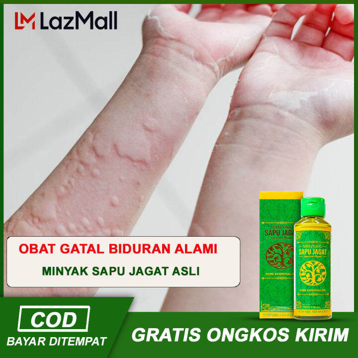 Obat Gatal Gatal Di Seluruh Badan Alergi Kulit Gatal Biduran Bentol