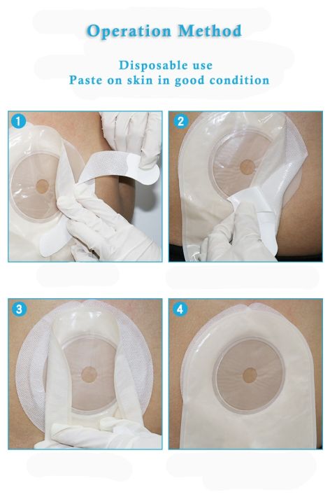 hot-20ชิ้น-ล็อตแบบพกพา-ostomy-care-เหล็กหล่อไฟฟ้าสำหรับกระเป๋าสำหรับลำไส้-anti-curl-up-anti-shedding-ostomy-กระเป๋าสำหรับ-stoma