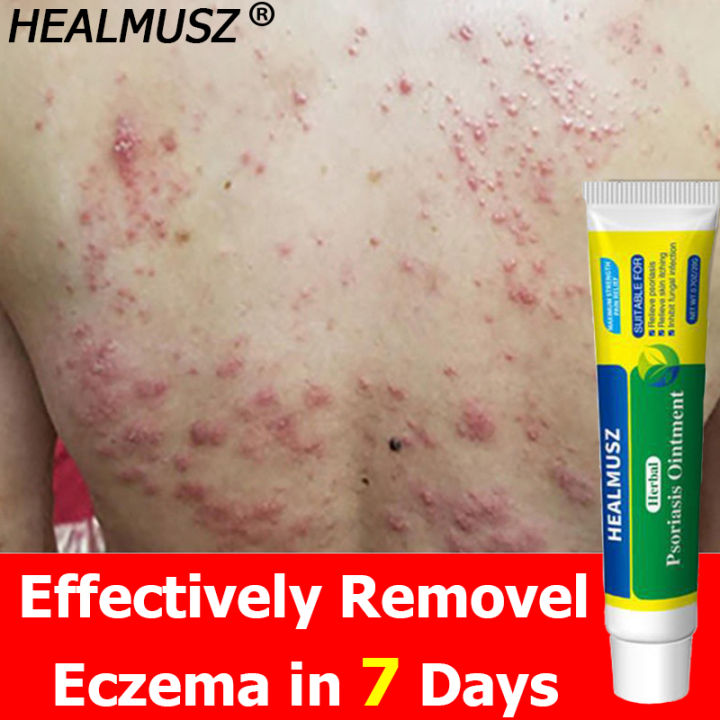 Seven days removal HEALMUSZ Skin Ointment Herbal Psoriasis sa kati kati ...