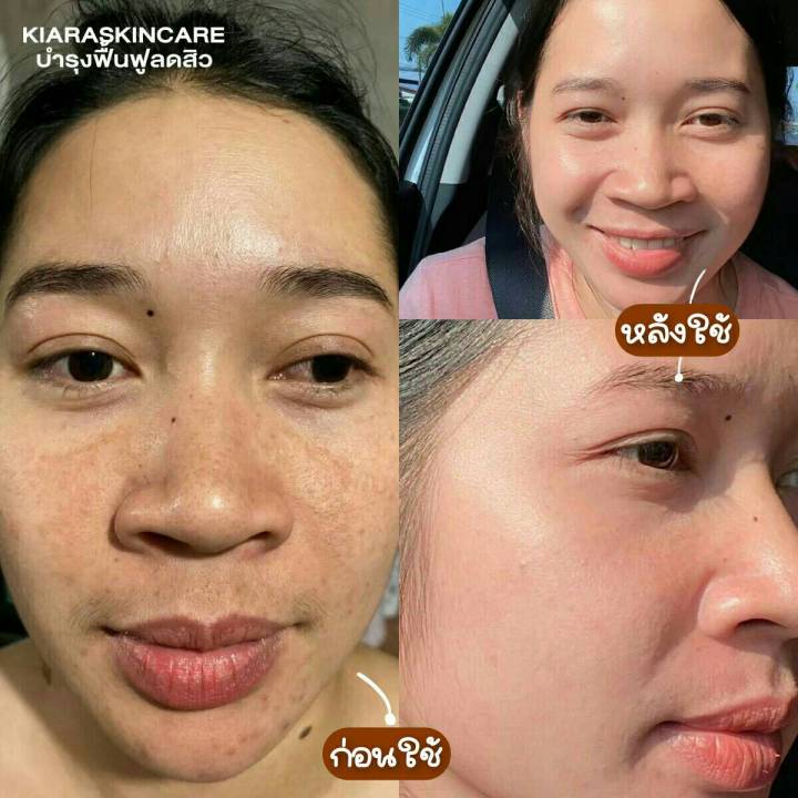 พร้อมส่ง-แพ็คาเกจใหม่-เคียร่า-ครีมหน้าใส-kiara-ลดสิว-ลดฝ้ากระ-จุดด่างดำจางไว3เท่า-หน้ากระจ่างใส