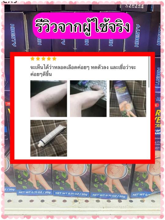 ส่งฟรี-hbesty-ครีมทาเส้นเลือดขอด-ขาสวย-บอกลาเส้นเลือดขอด-ครีมทาเส้นเลือดขอด-ขนาด-20-กรัม