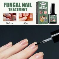 15ml Nail Care Solution To Treat Fungal Nails Anti fungal Onychomycosis Care Repair Thickened Nails Nail Care TSLM1