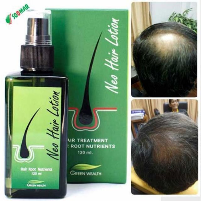 NEO HAIR LOTION 100% ORIGNAL SPRAY NEW ARRIVAL Hair Transplant and Hair Loss  Treatment GMP Products form Thailand Green Wealth Center Wholesale | Lazada