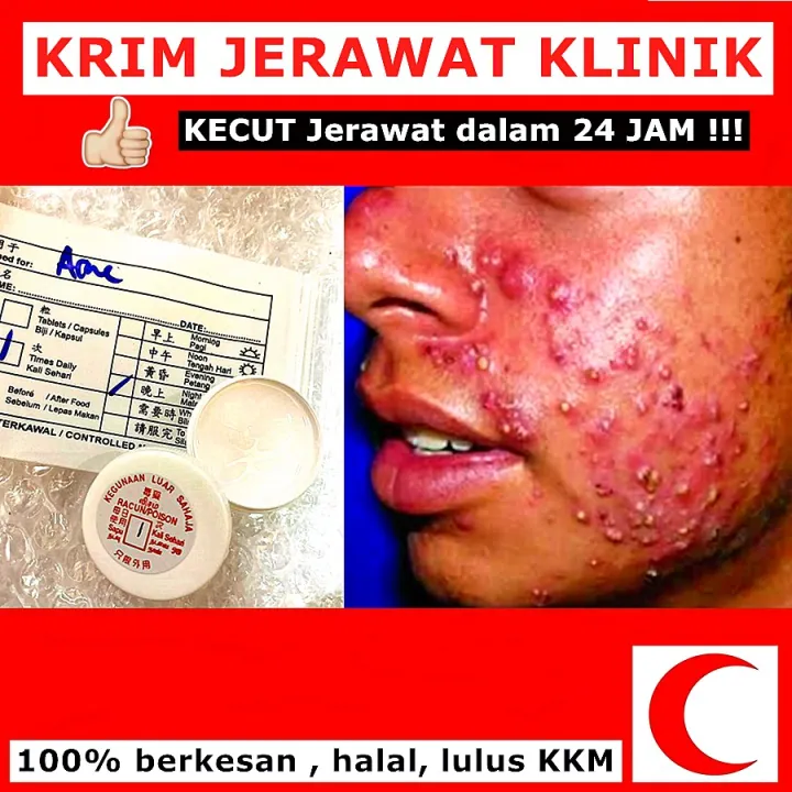 Krim Jerawat Kulit 100 Kecut Berkesan Pimples Skin Jerawat 5g 15g 100 Original Lazada