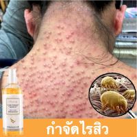 [บอกลาสิวหน้าอกและหลัง] HYQING ขจัดไร ลบสิว เจลอาบน้ำ ยับยั้งไร ป้อวกันสิวขึ้น ป้องกันผิวแห้งกร้าน ชุ่มชื่นซ่อมแซมและบำรุง สิวบนหลัง สบู่อาบน้ำ ครีมอาบน้ำหอมๆ ครีมอาบน้ำ ขจัดไร ลบสิว Mite Eliminating Ac 260ML