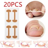 12/20pcs Toenail Patch Ingrown Toenail Correction Pedicure Tool Toe Inlay Nail Corrector Nail Patch Correction Stickers