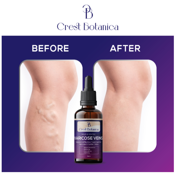 🔥 Effective! 🔥Must Try! CREST BOTANICA VARICOSE VEINS Treatment, 100