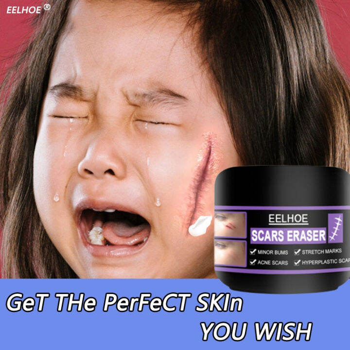 【COD】⚡ Scar Remover Peklat Remover Cream Original Acne Scar Remover