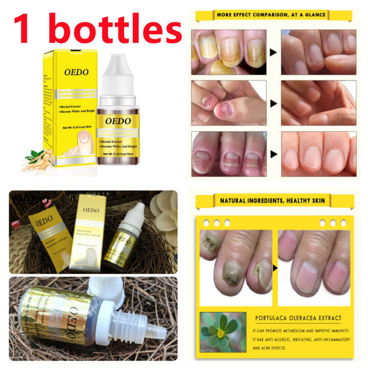 Fungal nail treatment foot care essence nail whitener toenail fungus removal antiinfective gel