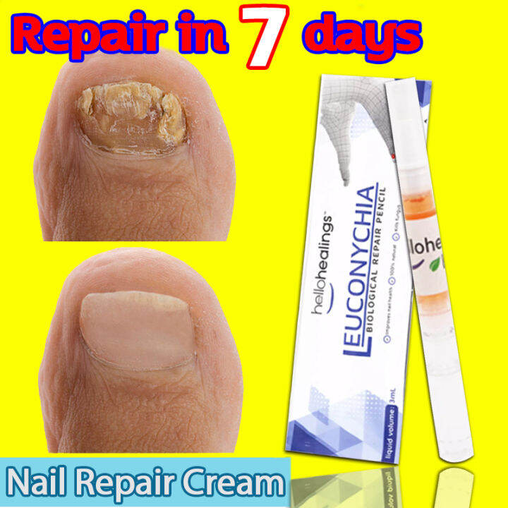 AICHUN Nail Treatment Serum Nail treatment fungal Ingrown Toenail