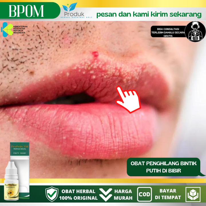 Obat Bintik Putih Di Bibir Obat Penghilang Bintik Putih Di Bibir Fordyce Spots Bintik Putih