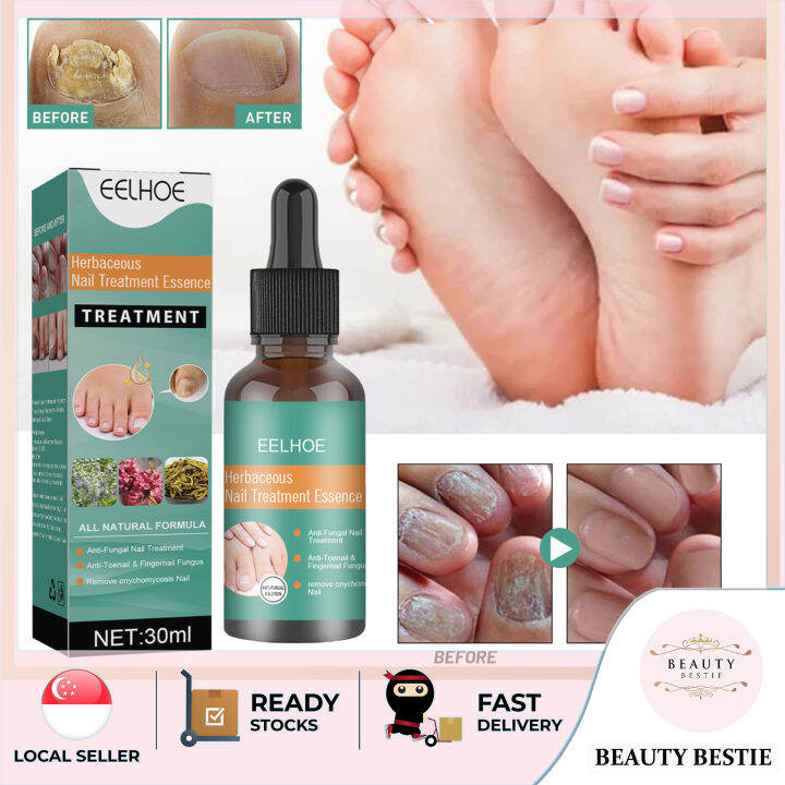 *EELHOE* HERBACEOUS NAILS REPAIRING SERUM ONYCHOMYCOSIS PARONYCHIA ANTI ...