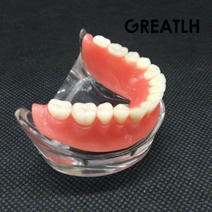 dental-overdenture-interior-mandibular-lower-teeth-model-mandibular-with-implant-restoration-tooth-dental-teaching-study