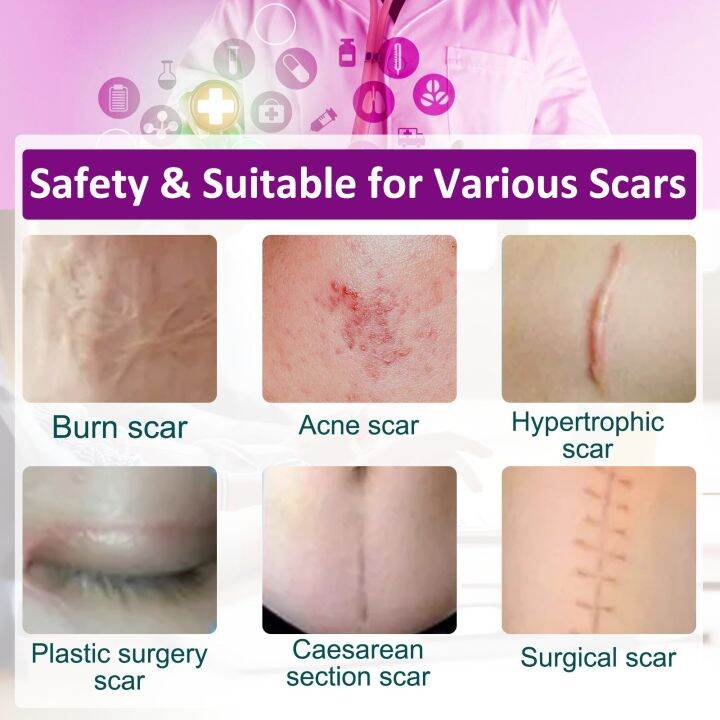 aliver-medical-silicone-gel-strips-patch-scar-away-tape-treatment-repair-skin-sheet-for-acne-trauma-burn-scar-skin-repair