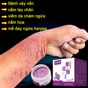 kem loại chống khuẩn giảm ngứa Bệnh vảy nến nấm tay chân viêm da chàm ngứa