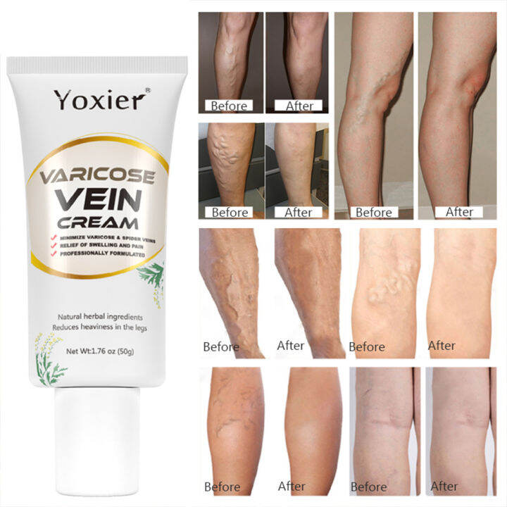 Vein Care Leg Cream for Varicose Veins & Spider Veins Skin Care Vein