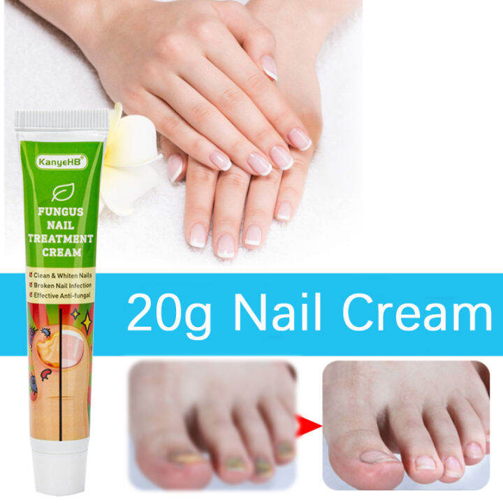 20g Nail Cream Fungus Treatment Cream Removal Nail Paronychia ...