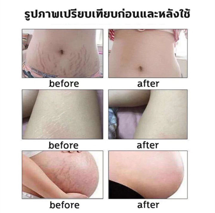 พร้อมส่ง-ใช้ได้ทั้งรอยแตกลายใหม่และเก่า-ครีมรอยแตกลาย-ครีมลอยแตกลาย-ครีมทาแตกลาย-ครีมแก้แตกลาย-ครีมทาท้องลาย-ครีมทาขาแตกลาย-ครีมลดรอยแตก-ครีมทารอยแตกลาย