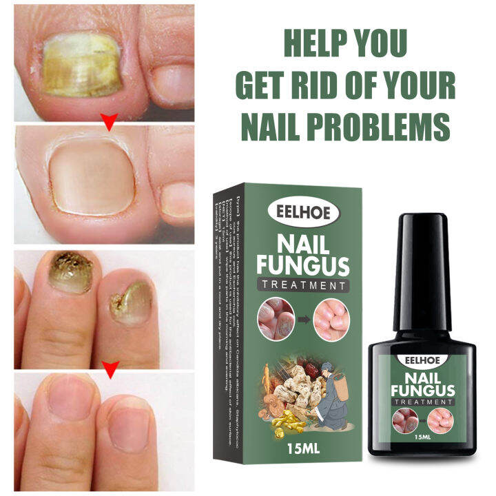 Nail Fungal Cure Nail Fungus Removal Liquid Nutritious Anti Paronychia
