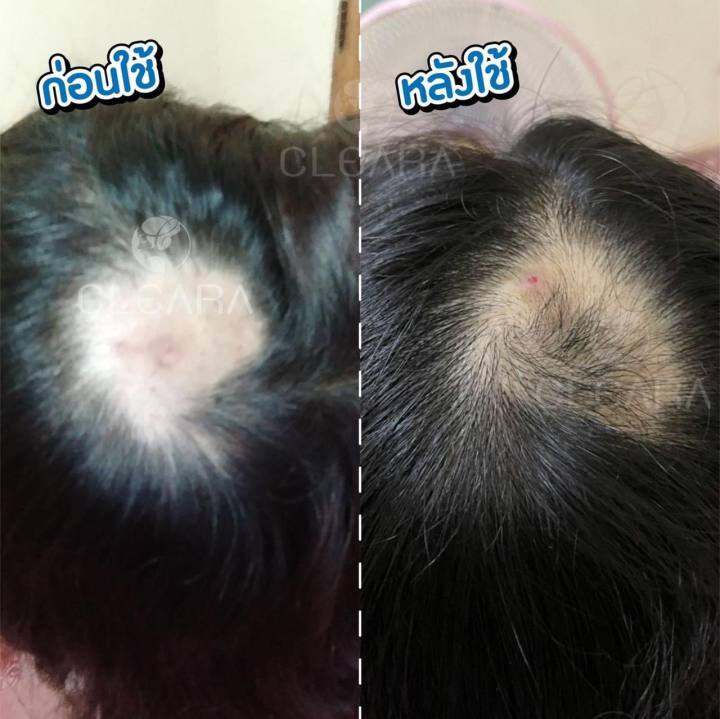 เซ็ท2ขวด-cleara-serum-ส่งฟรีส่งด่วนใน1วัน-เคลียร่า-เซรั่มปลูกผม-ลดผมร่วง-กระตุ้นผมใหม่-เซรั่มปลูกคิ้ว-ผมแข็งแรง-เส้นผมแข็งแรง-15ml