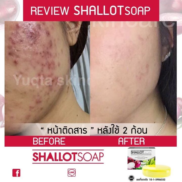 shallot-soap-สบู่หอมแดง-3-ก้อน-ส่งฟรี-หน้ากระจ่างงใส-ผิวนุ่ม-สิว-ฝ้า-กระ-จุดด่างดำ