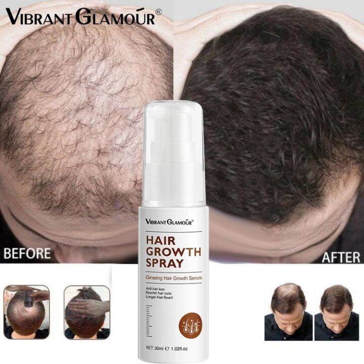 【cod】 Hair Growth Serum Spray Fast Hair Grower For Man And Woman