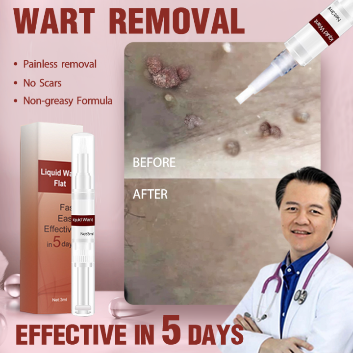 Warts Remover Original Warts Removal Warts Remover Original Watson Skin ...