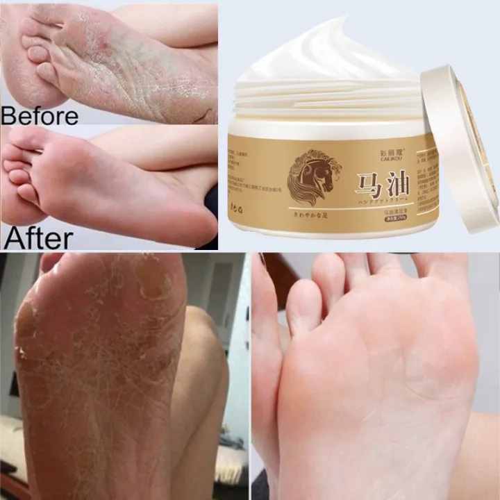Foot Cream for Dry and Rough Heels, Cracked Heel Cream, Moisturizing
