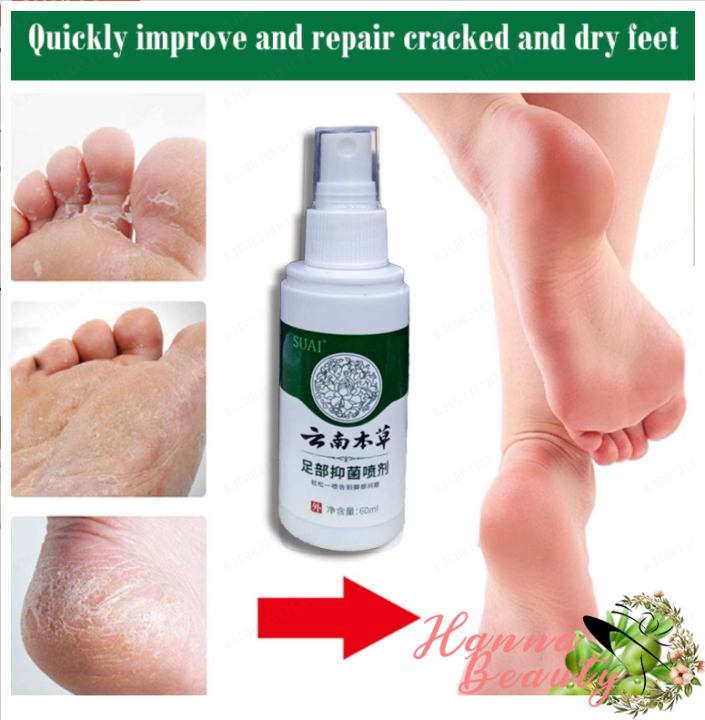 Athlete's foot treatment herbal antibacterial spray Lazada PH