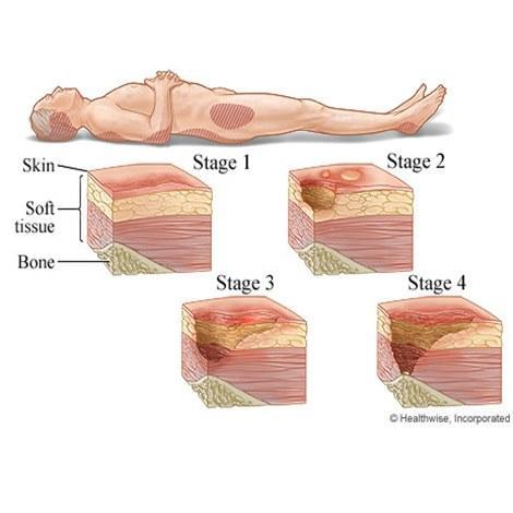 เบาะแผ่นรองขารักษาแผลกดทับที่ต้นขา-หมอนรองขา-mybow-knee-pillow-leg-แผลกดทับ-ขาเข้าเฝือก