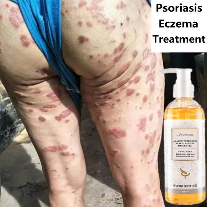 Shower Gel Eczema Treatmen Remove Acne Mites Shower Gel Anti Itch