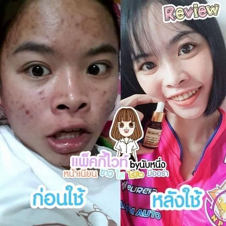 แพคกี้ไวท์-หน้าใส-ลดสิว-ลดกระหน่ำ-ไปเลยจ้า