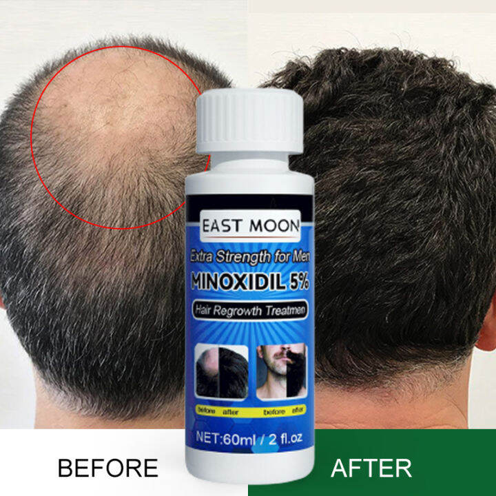 CINDYNAL Minoxidil 5% Hair Grower For Men Original Hair Treatment Anti ...