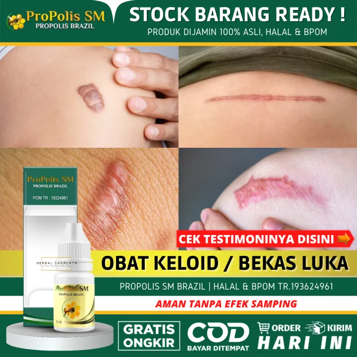 Obat Keloid Daging Tumbuh Daging Jadi Obat Benjolan Penghilang