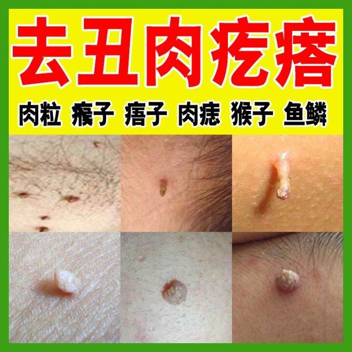 Remove thorn wart skin flabby medicine to small grains pimple monkey ...