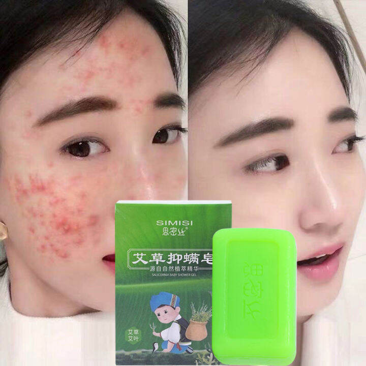 Soap Anti Fungus Acne Psoriasis Seborrhea Eczema Bath Scented Soap