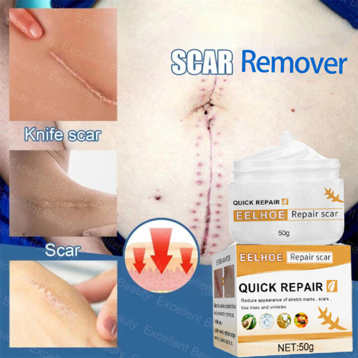 Eelhoe Stretch Mark And Scar Remover Cream 50g Old Scar Remover For