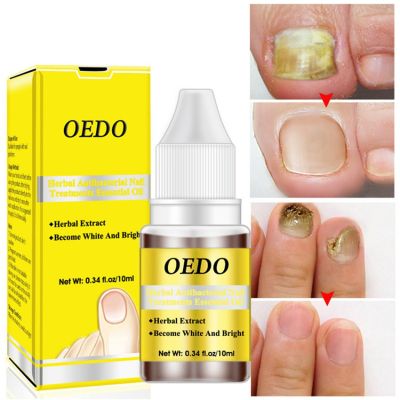 *ส่งจากไทย* OEDO สมุนไพร Antibacterial เล็บน้ำมันหอมระเหย 10ml Bactericidal น้ำมันสกัดธรรมชาติยาทาเล็บ รหัส 5028