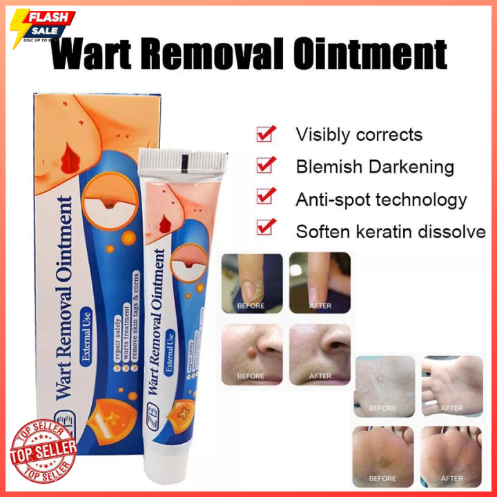 Warts Remover Original Cream Warts Magic Remover Wartz Removal Cream ...