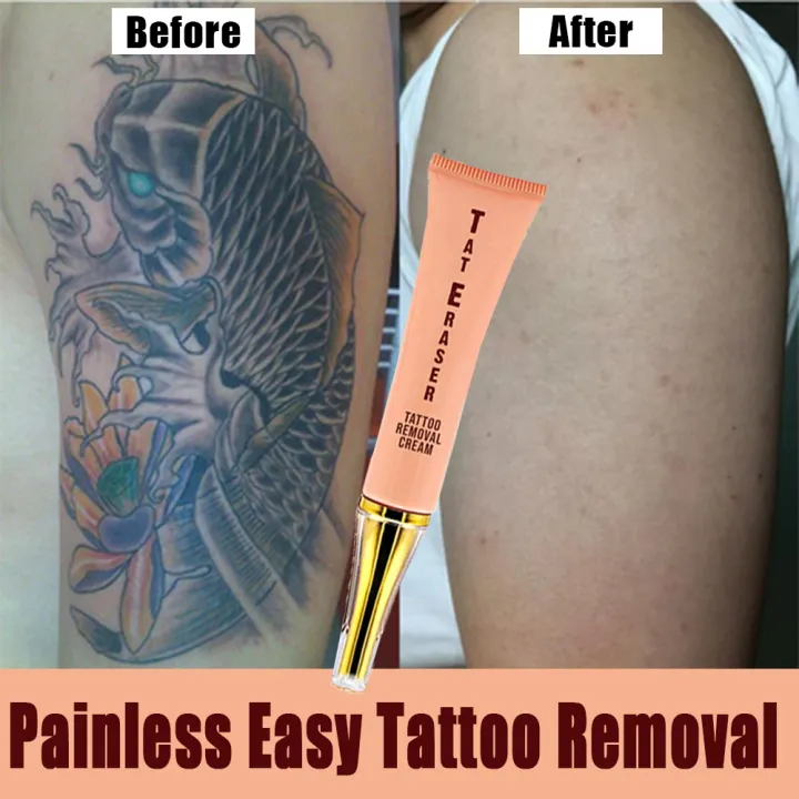 Tattoo Removal Twin Cities  AllNatural NonLaser Tattoo Removal