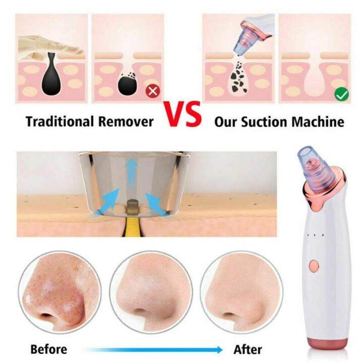 facial-diamond-dermabrasion-blackhead-vacuum-cleaner-pore-vacuum-acne-pimple-removal-suction-black-dots-extractor-skin-care-tool