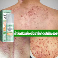 สเปรย์ลดสิว แผ่นหลัง และลำตัว Body Acne Spray 120 ml ลดปัญหาสิวที่แผ่นหลัง และลำตัว