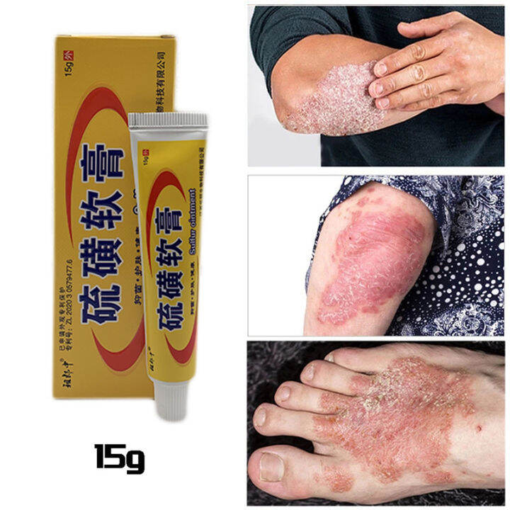 Sulfur Eczema Psoriasis Treatment Cream Topical Medicated Chinese