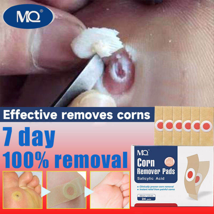 24pcs/box warts remover patch Pain relief, remove calluses on hands and ...