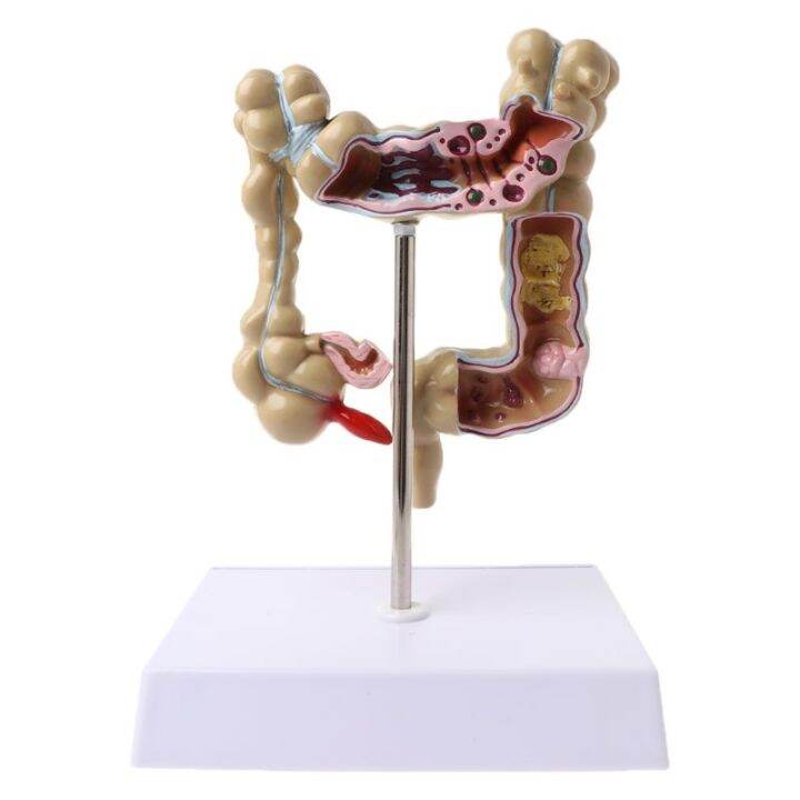 blg Human Colorectal Lesion Model Pathological Anatomy Colon Diseases ...