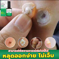 JAYSUING โลชั่นบำรุงเท้า10ml ลอกหูดตาปลา สลายติ่งเนื้อและไฝ รักษาตาปลา โดยที่ไม่ทิ้งร่องรอย เห็นผลดีเมื่อใช้ต่อเนื่อง ใช้ง่าย （ ผิวหนังหนา ）