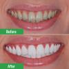Lanbena tinh chất tẩy trắng răng teeth clean spot cleaning làm sạch răng - ảnh sản phẩm 4