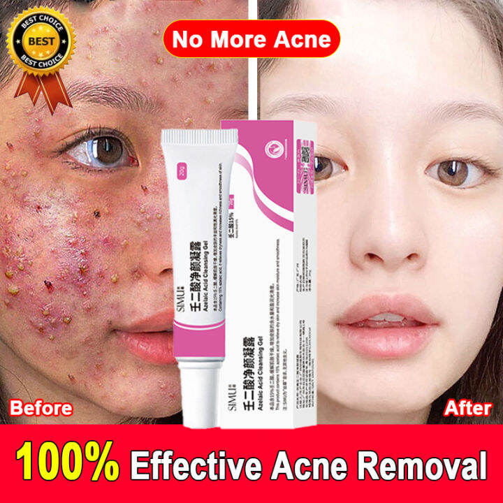 Acne Cream Multi Repair Fade Acne Marks Cream Accelerated Skin Repair ...