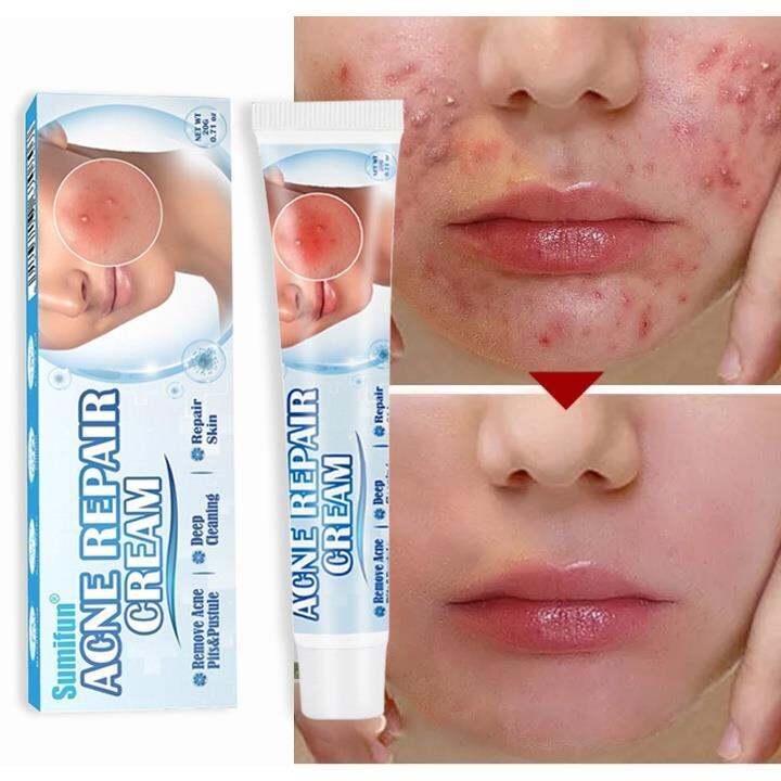 20g Sumifun Acne Treatment Remover Cream Remove Acne/Pimple Marks