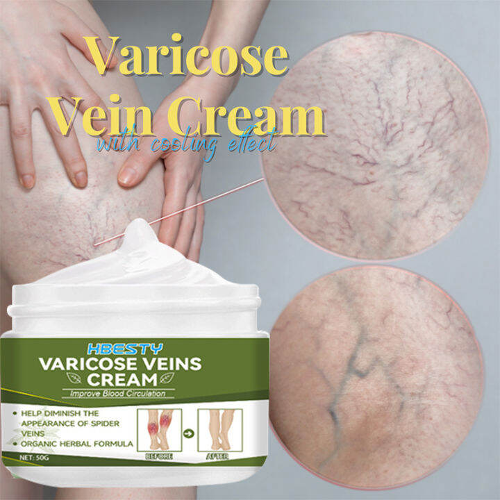 Varicose Vein Cream 50g Varicose Vein Ointment Relieve varicose veins ...